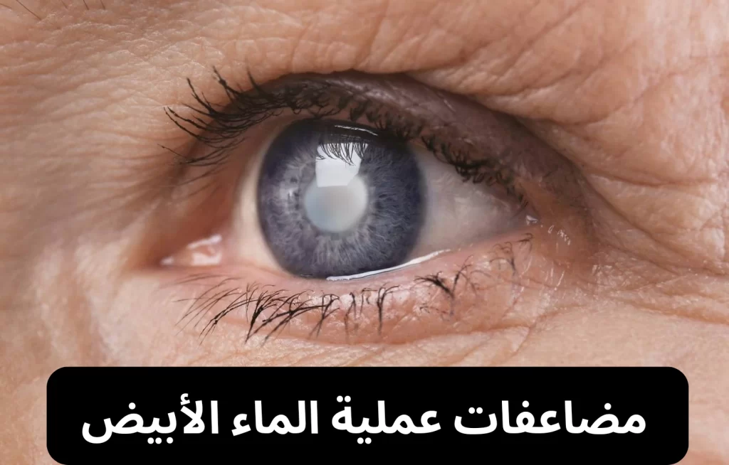 عملية الماء الأبيض 20240806 171539 0000 مضاعفات عملية الماء الأبيض