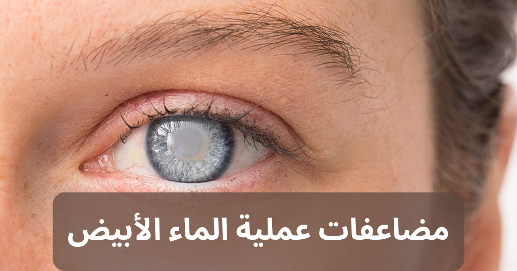 عملية الماء الأبيض 20240806 172054 0000 مضاعفات عملية الماء الأبيض