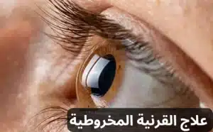القرنية المخروطية 20240923 022129 0000 المدونة