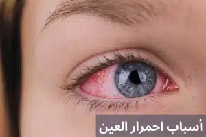 المدونة 2 احمرار العين 20241216 230459 0000 المدونة