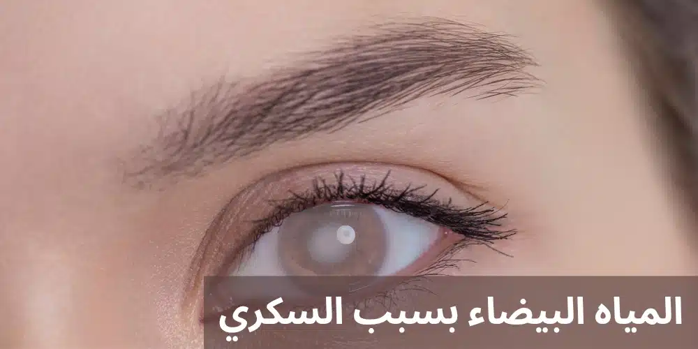 المياه البيضاء بسبب السكري
