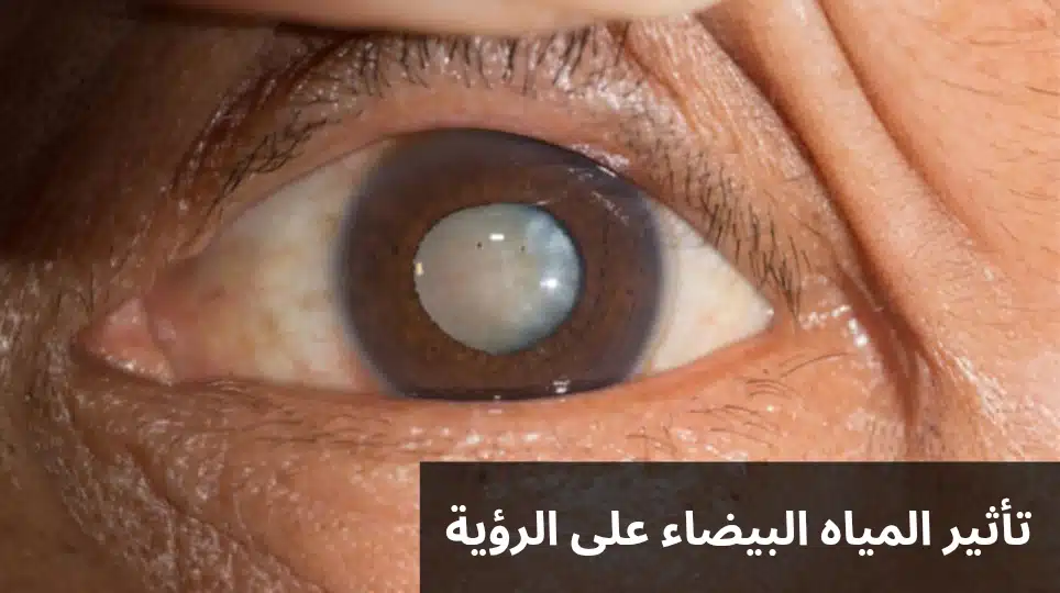 تأثير المياه البيضاء على الرؤية 3 1000271702 تأثير المياه البيضاء على الرؤية
