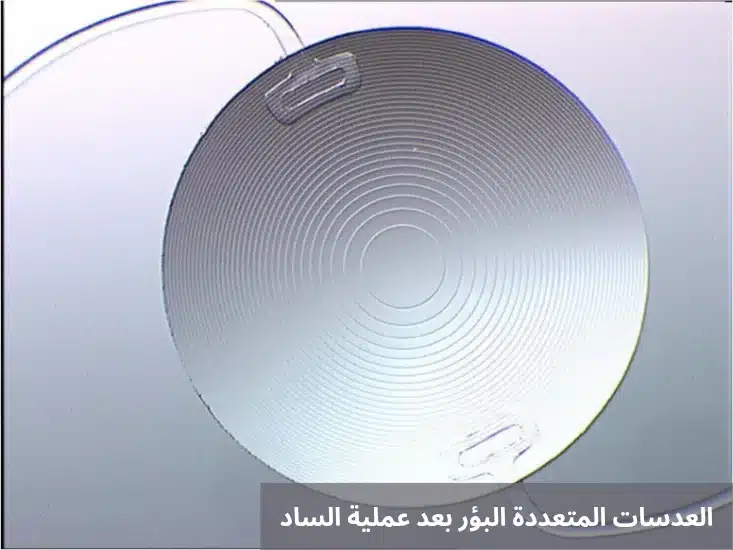 العدسات المتعددة البؤر بعد عملية الساد 2 1000271826 العدسات المتعددة البؤر بعد عملية الساد