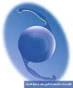 العدسات المتعددة البؤر بعد عملية الساد 3 1000271827 العدسات المتعددة البؤر بعد عملية الساد