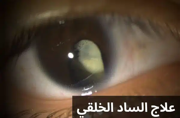 علاج الساد الخلقي 1 علاج الساد الخلقي