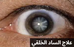 علاج الساد الخلقي 2 1000272373 علاج الساد الخلقي
