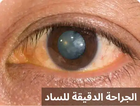 1000272642 الجراحة الدقيقة للساد