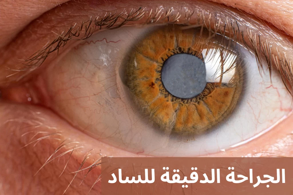 مخاطر الجراحة الدقيقة للساد