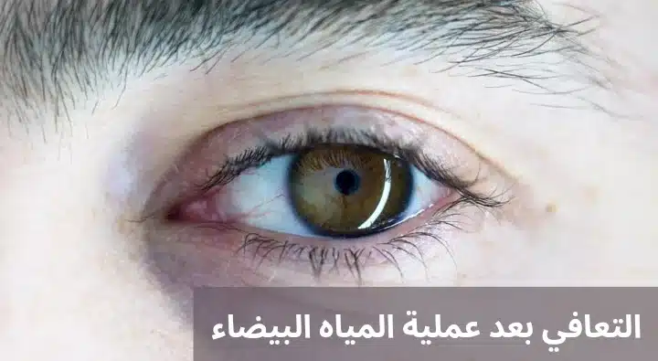 التعافي بعد عملية المياه البيضاء 1 التعافي بعد عملية المياه البيضاء