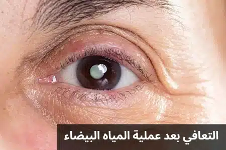 التعافي بعد عملية المياه البيضاء 2 1000273004 التعافي بعد عملية المياه البيضاء