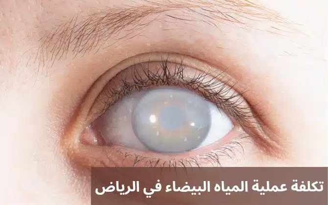 تكلفة عملية المياه البيضاء في الرياض 1 تكلفة عملية المياه البيضاء في الرياض