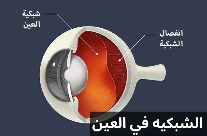 الشبكيه في العين 3 1000275742 الشبكيه في العين