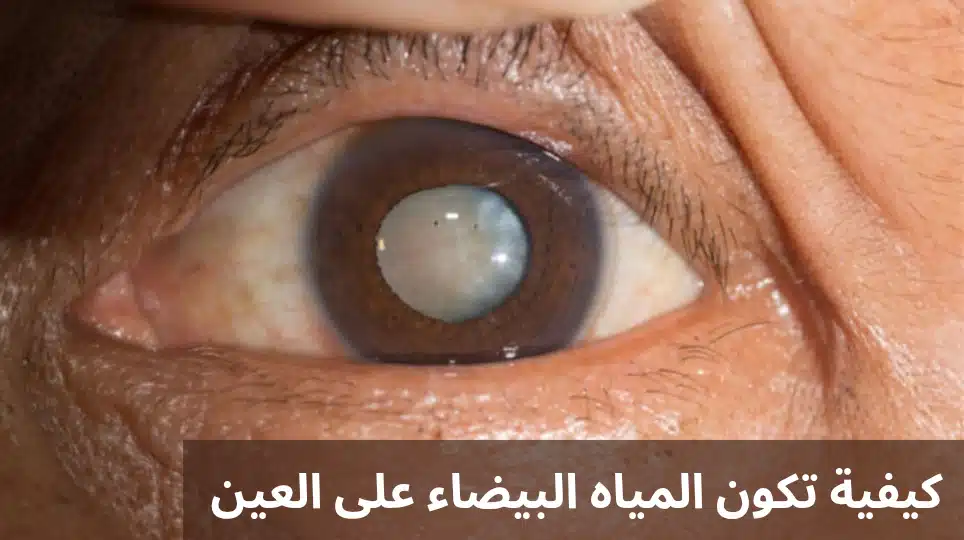 كيفية تكون المياه البيضاء في العين 1 1000276337 كيفية تكون المياه البيضاء في العين