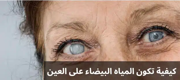 كيفية تكون المياه البيضاء في العين 2 كيفية تكون المياه البيضاء في العين