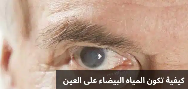 كيفية تكون المياه البيضاء في العين 3 1000276339 كيفية تكون المياه البيضاء في العين