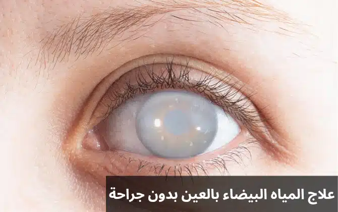 علاج المياه البيضاء بالعين بدون جراحة 1 علاج المياه البيضاء بالعين بدون جراحة