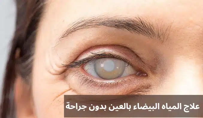 علاج المياه البيضاء بالعين بدون جراحة 2 1000277016 علاج المياه البيضاء بالعين بدون جراحة
