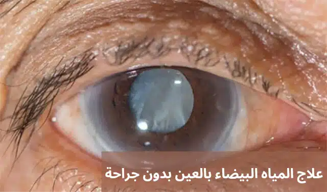 علاج المياه البيضاء بالعين بدون جراحة 3 1000277017 علاج المياه البيضاء بالعين بدون جراحة