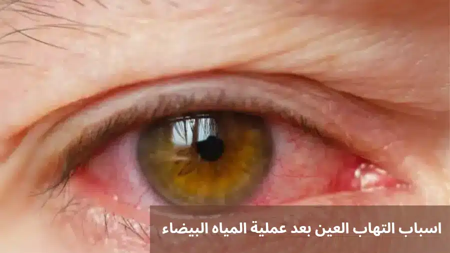 اسباب التهاب العين بعد عملية المياه البيضاء 2 اسباب التهاب العين بعد عملية المياه البيضاء