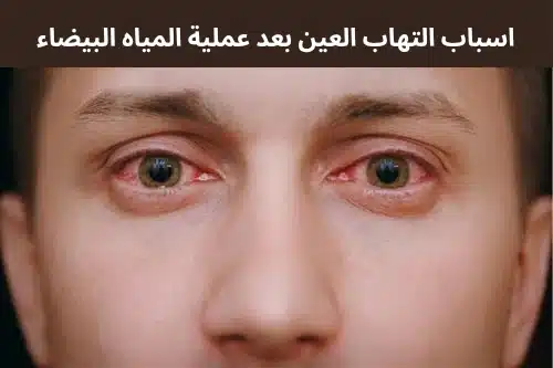 اسباب التهاب العين بعد عملية المياه البيضاء 3 1000280074 اسباب التهاب العين بعد عملية المياه البيضاء