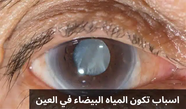 اسباب تكون المياه البيضاء في العين 1 اسباب تكون المياه البيضاء في العين