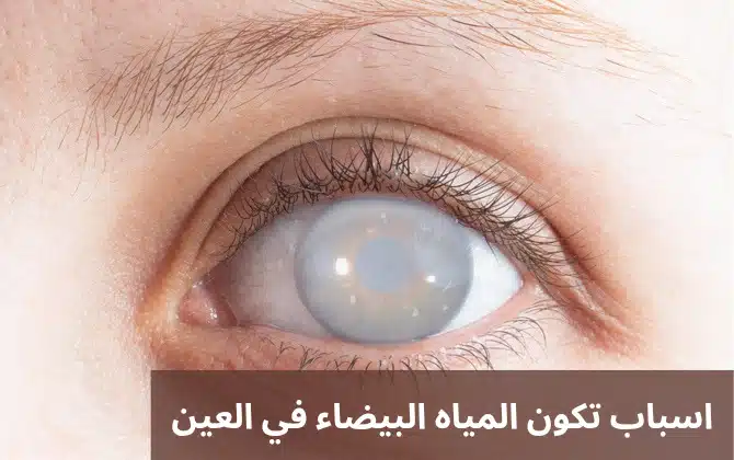 اسباب تكون المياه البيضاء في العين 2 1000281047 اسباب تكون المياه البيضاء في العين