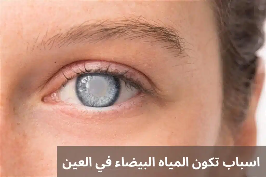 اسباب تكون المياه البيضاء في العين 3 1000281048 اسباب تكون المياه البيضاء في العين
