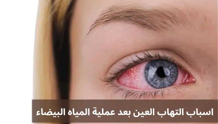 اسباب التهاب العين بعد عملية المياه البيضاء 1 التهاب العين بعد عملية المياه البيضاء 20250429 010715 0000 اسباب التهاب العين بعد عملية المياه البيضاء