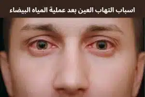 المدونة 4 التهاب العين بعد عملية المياه البيضاء 20250429 011335 0000 المدونة