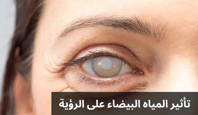 تأثير المياه البيضاء على الرؤية 1 تأثير المياه البيضاء على الرؤية
