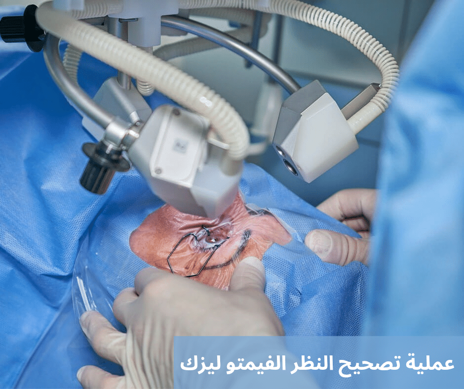 عملية تصحيح النظر الفيمتو ليزك 2 عملية تصحيح النظر الفيمتو ليزك