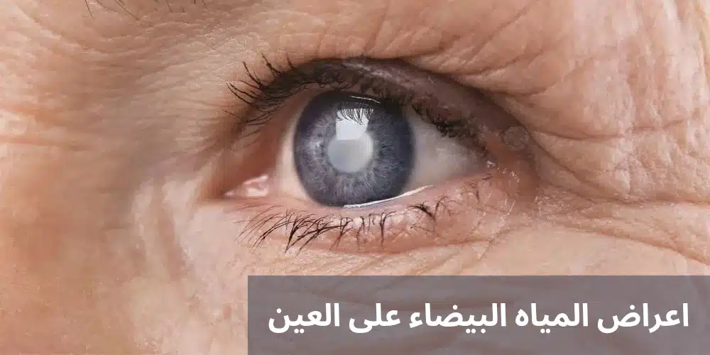 اعراض المياه البيضاء على العين 1 اعراض المياه البيضاء على العين