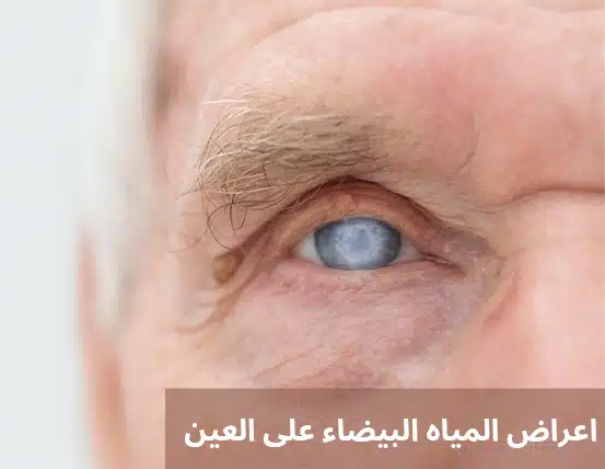 اعراض المياه البيضاء على العين 2 1000281518 اعراض المياه البيضاء على العين