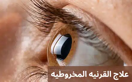 علاج القرنيه المخروطيه 1 علاج القرنيه المخروطيه