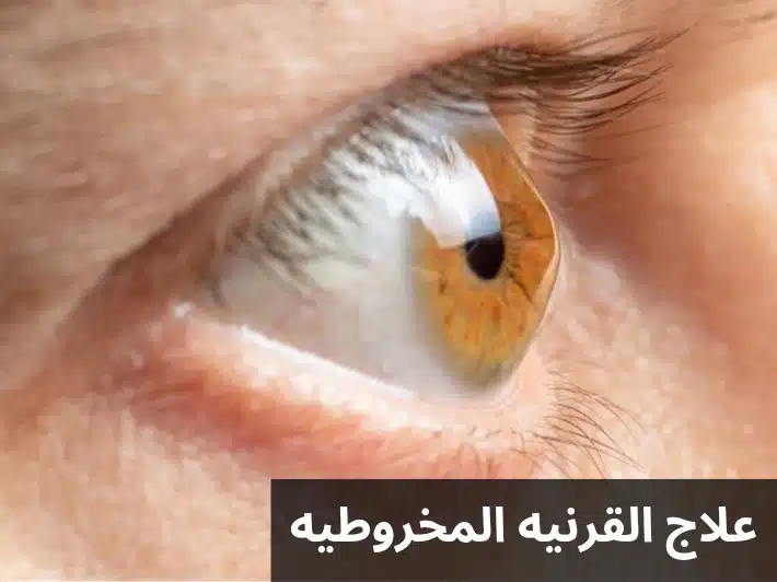 علاج القرنيه المخروطيه 2 1000282147 علاج القرنيه المخروطيه