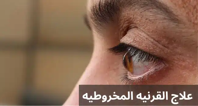 علاج القرنيه المخروطيه 3 1000282148 علاج القرنيه المخروطيه