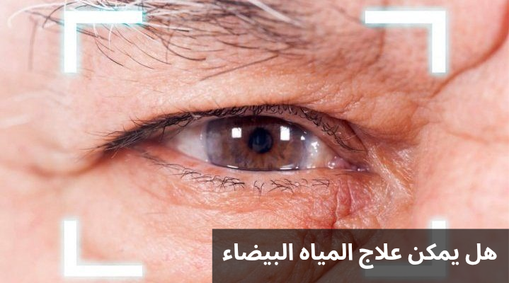 هل يمكن علاج المياه البيضاء 1 1000283044 هل يمكن علاج المياه البيضاء