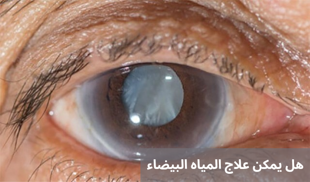 هل يمكن علاج المياه البيضاء 2 1000283045 هل يمكن علاج المياه البيضاء