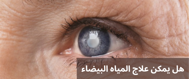 هل يمكن علاج المياه البيضاء 3 هل يمكن علاج المياه البيضاء