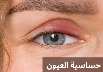 حساسية العيون 1 حساسية العيون