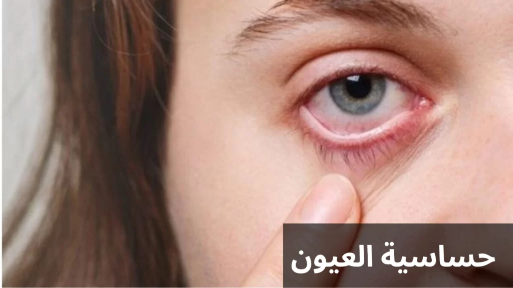 حساسية العيون 2 1000284545 حساسية العيون