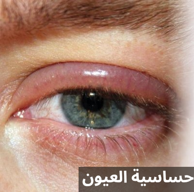 حساسية العيون 3 1000284546 حساسية العيون
