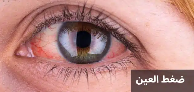 ضغط العين 1 ضغط العين