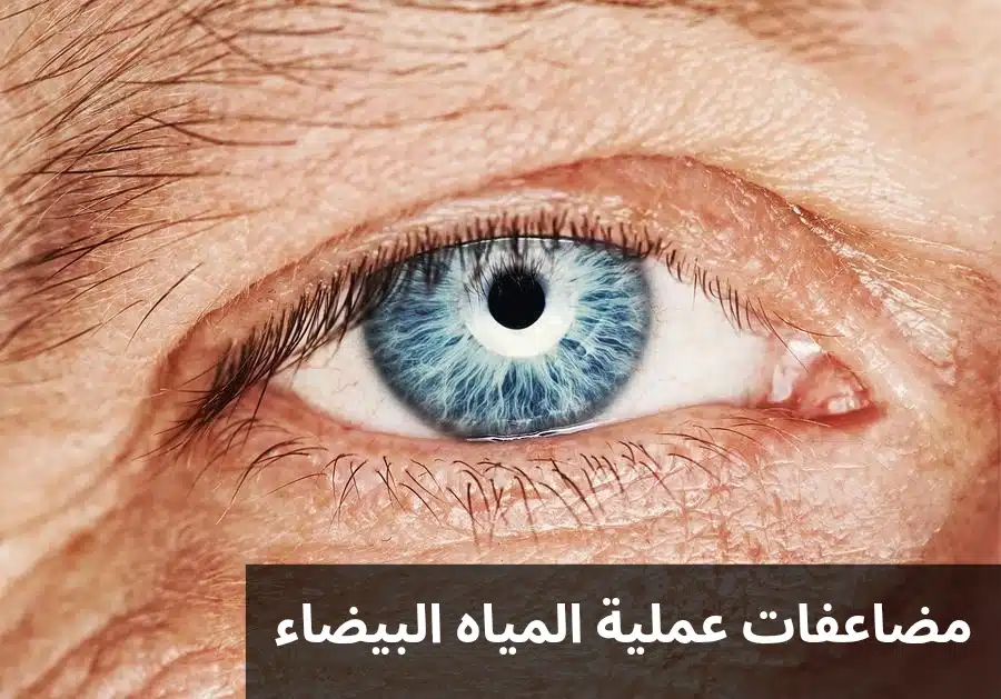 مضاعفات عملية المياه البيضاء 2 1000287072 مضاعفات عملية المياه البيضاء