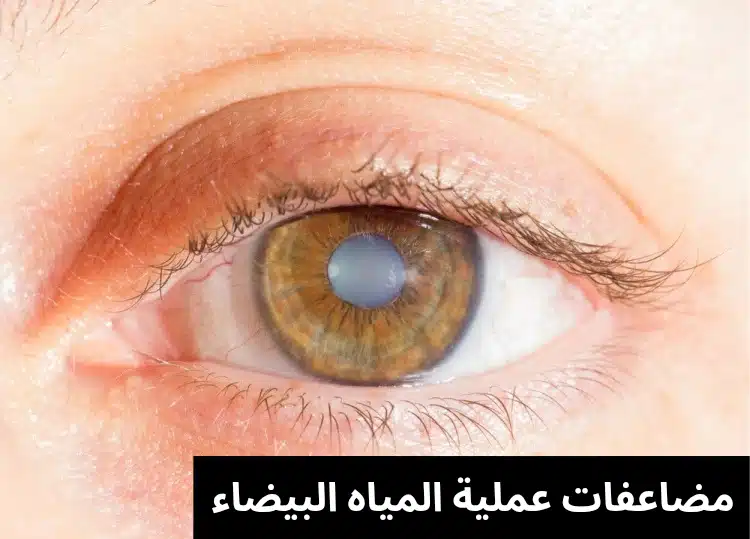 مضاعفات عملية المياه البيضاء 3 1000287073 مضاعفات عملية المياه البيضاء