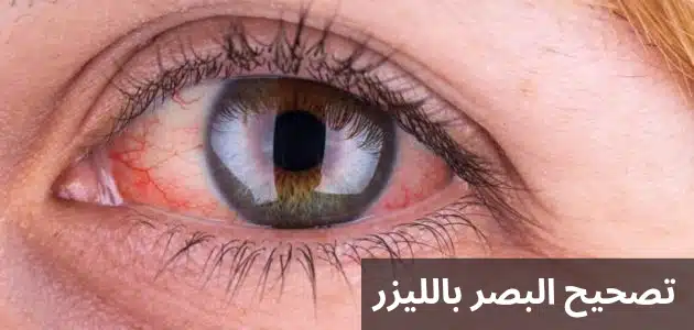تصحيح البصر بالليزر 1 تصحيح البصر بالليزر