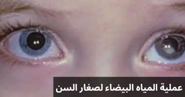 عملية المياه البيضاء لصغار السن 1 عملية المياه البيضاء لصغار السن
