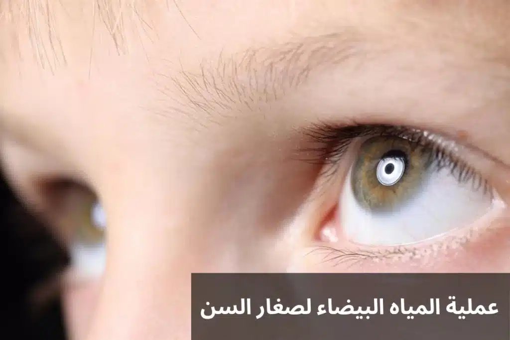 عملية المياه البيضاء لصغار السن 2 1000288508 عملية المياه البيضاء لصغار السن