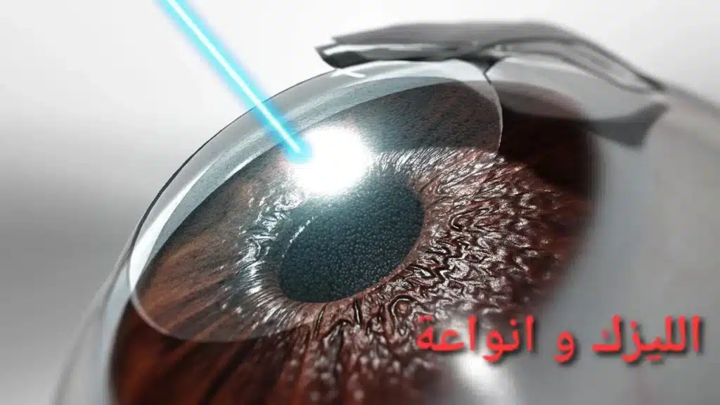 الليزك و انواعة 2 1000288821 الليزك و انواعة