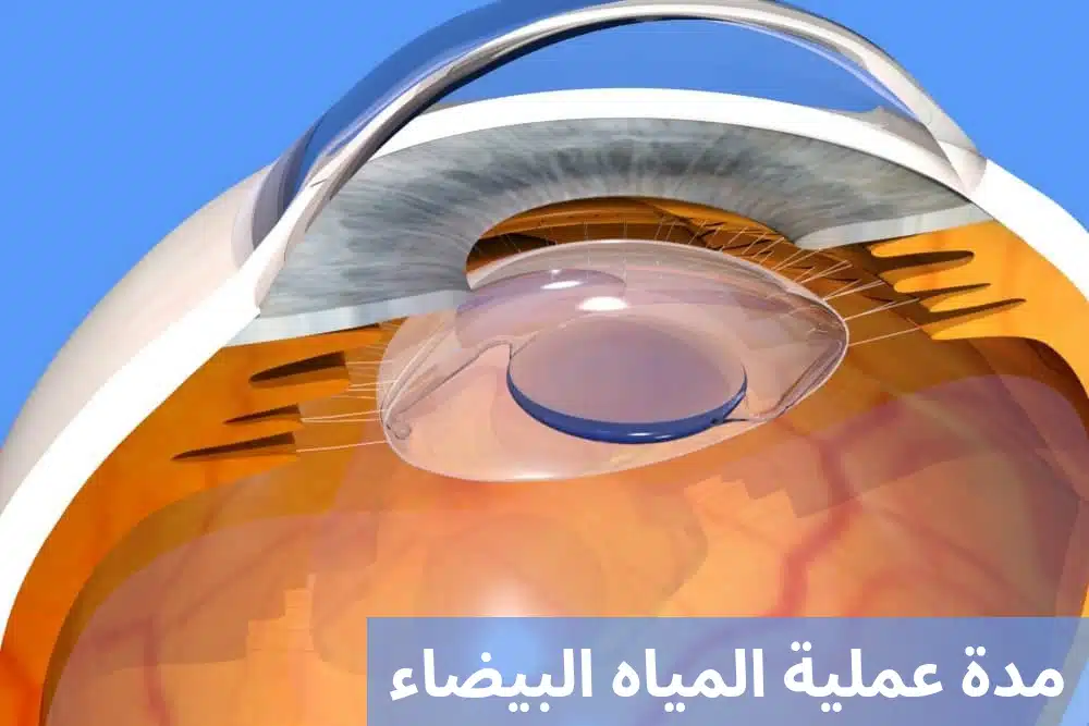 1000290117 مدة عملية المياه البيضاء